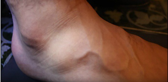 Qué es la inflamación