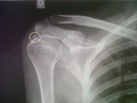 FISIOTERAPIA EN EL HOMBRO: Tendinitis en el manguito rotador