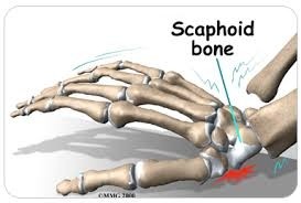 FISIOTERAPIA EN FRACTURA DE ESCAFOIDES