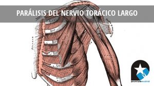 PARALISIS-NERVIO-TORACICO