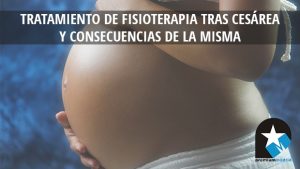 tratamiento de fisioterapia cesarea - Premium Madrid