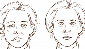 La Parálisis de Bell o Parálisis Facial Periférica, ¿cómo se cura?