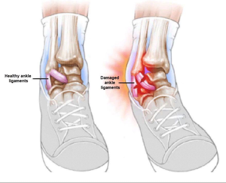 Inestabilidad de tobillo: causas, tratamiento y prevención