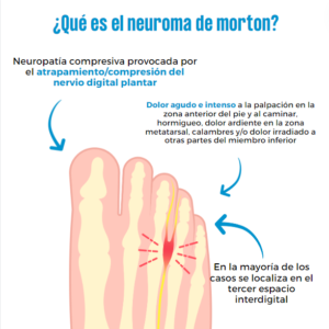 Neuroma de morton